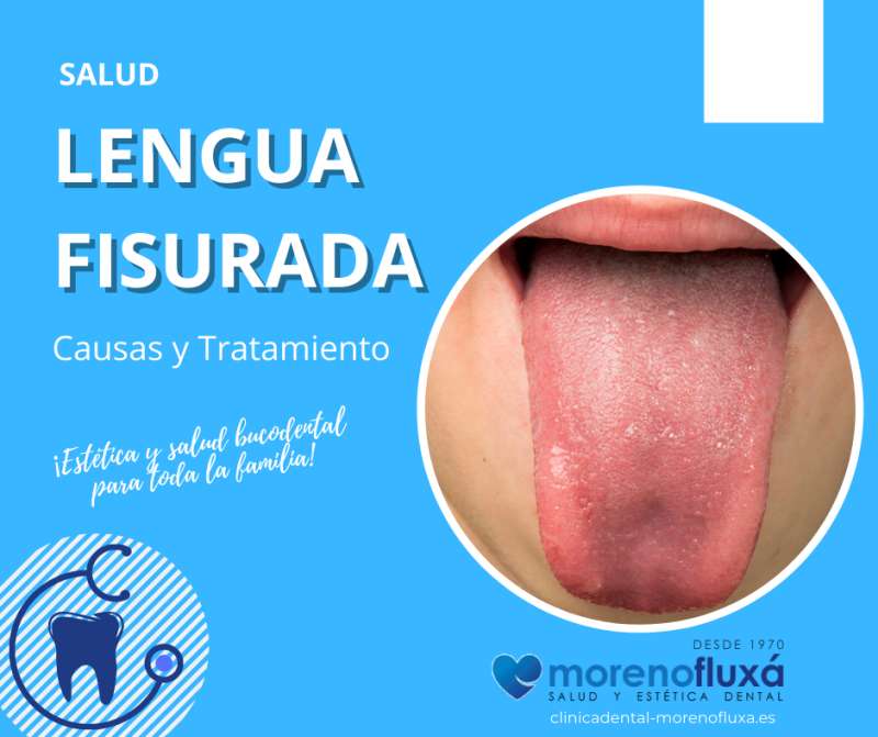 ¿Qué es la lengua agrietada?