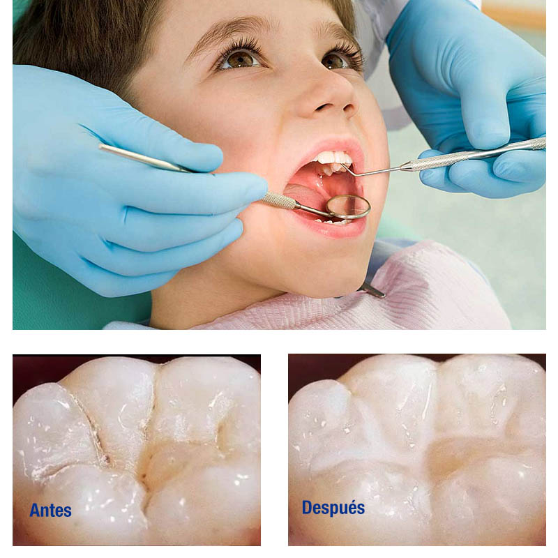 Selladores dentales para niños