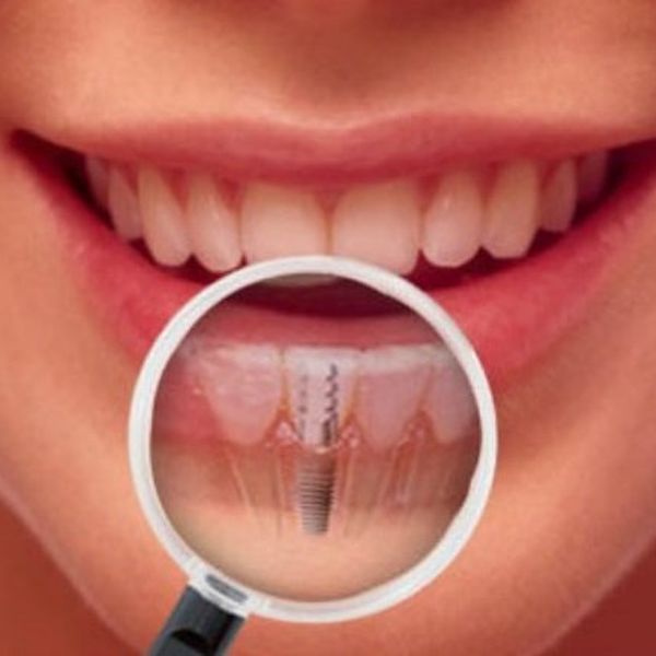 ¿Qué es una cirugía de implante dental?